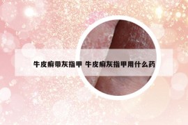 牛皮癬帶灰指甲 牛皮癬灰指甲用什么藥