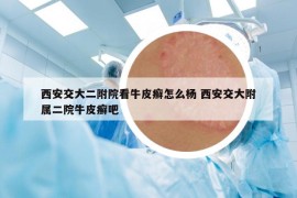西安交大二附院看牛皮癬怎么楊 西安交大附屬二院牛皮癬吧