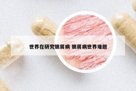 世界在研究銀屑病 銀屑病世界難題