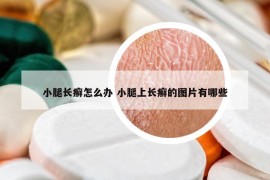 小腿長(zhǎng)癬怎么辦 小腿上長(zhǎng)癬的圖片有哪些