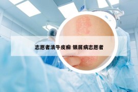 志愿者清牛皮癬 銀屑病志愿者