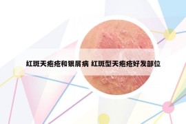 紅斑天皰瘡和銀屑病 紅斑型天皰瘡好發(fā)部位