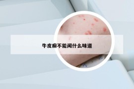 牛皮癬不能聞什么味道