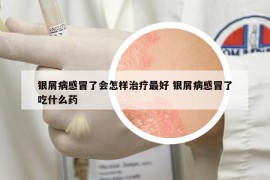 銀屑病感冒了會怎樣治療最好 銀屑病感冒了吃什么藥