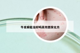 牛皮癬能治好嗎高效西安北方