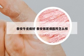 泰安牛皮癬好 泰安銀屑病醫(yī)院怎么樣