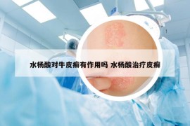 水楊酸對牛皮癬有作用嗎 水楊酸治療皮癬