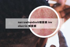 narrowbanduvb銀屑病 involucrin 銀屑病