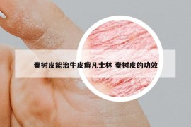 秦樹皮能治牛皮癬凡士林 秦樹皮的功效