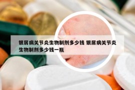 銀屑病關(guān)節(jié)炎生物制劑多少錢 銀屑病關(guān)節(jié)炎生物制劑多少錢一瓶
