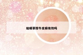 蛤蟆草擦牛皮癬有效嗎