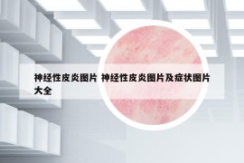 神經(jīng)性皮炎圖片 神經(jīng)性皮炎圖片及癥狀圖片大全