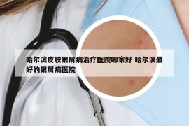 哈爾濱皮膚銀屑病治療醫(yī)院哪家好 哈爾濱最好的銀屑病醫(yī)院