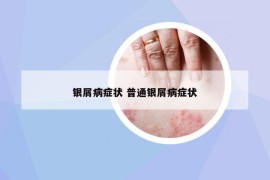銀屑病癥狀 普通銀屑病癥狀