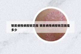 銀屑病慢病報銷范圍 銀屑病慢病報銷范圍是多少