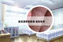 盤狀濕疹銀屑病 盤形皮疹