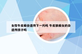 女性牛皮癬會遺傳下一代嗎 牛皮膚癬女的會遺傳孩子嗎