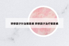 轉(zhuǎn)移因子針治銀屑病 轉(zhuǎn)移因子治療銀屑病