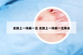 皮膚上一塊癬一流 皮膚上一塊癬一流黃水