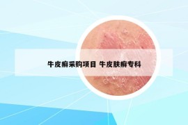 牛皮癬采購項目 牛皮膚癬?？? /></a>		
		</figure>

		<header class=