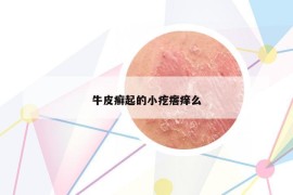 牛皮癬起的小疙瘩癢么