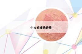 牛皮癬癥狀輕重