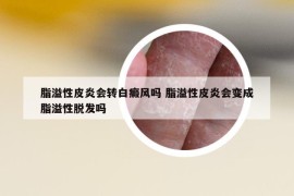 脂溢性皮炎會(huì)轉(zhuǎn)白癜風(fēng)嗎 脂溢性皮炎會(huì)變成脂溢性脫發(fā)嗎