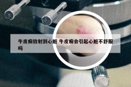 牛皮癬放射到心臟 牛皮癬會(huì)引起心臟不舒服嗎
