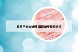 銀屑甲能治好嗎 銀屑病甲能根治嗎