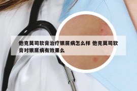 他克莫司軟膏治療銀屑病怎么樣 他克莫司軟膏對銀屑病有效果么