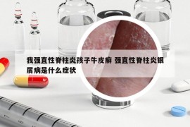 我強(qiáng)直性脊柱炎孩子牛皮癬 強(qiáng)直性脊柱炎銀屑病是什么癥狀