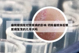 扁桃腺摘除對銀屑病的影響 切除扁桃體后銀屑病復發(fā)的幾率大嗎