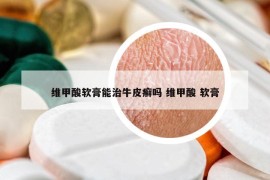 維甲酸軟膏能治牛皮癬嗎 維甲酸 軟膏