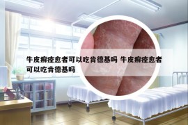 牛皮癬痊愈者可以吃肯德基嗎 牛皮癬痊愈者可以吃肯德基嗎