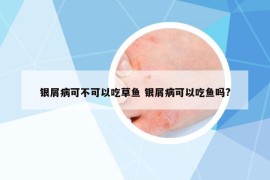 銀屑病可不可以吃草魚 銀屑病可以吃魚嗎?