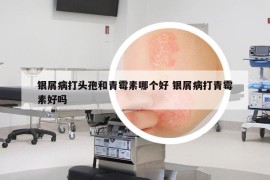銀屑病打頭孢和青霉素哪個(gè)好 銀屑病打青霉素好嗎