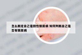 怎么斷定自己是假性銀屑病 如何判斷自己是否有銀屑病