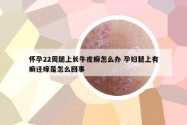 懷孕22周腿上長牛皮癬怎么辦 孕婦腿上有癬還癢是怎么回事
