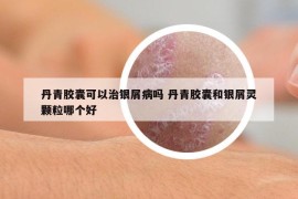 丹青膠囊可以治銀屑病嗎 丹青膠囊和銀屑靈顆粒哪個好