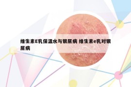維生素E乳保溫水與銀屑病 維生素e乳對(duì)銀屑病