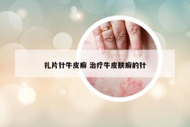 扎片針牛皮癬 治療牛皮膚癬的針