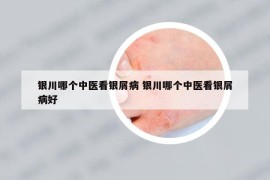 銀川哪個(gè)中醫(yī)看銀屑病 銀川哪個(gè)中醫(yī)看銀屑病好
