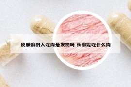 皮膚癬的人吃肉是發(fā)物嗎 長癬能吃什么肉