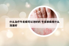 什么治療牛皮癬可以泡好的 牛皮膚癬用什么泡澡好