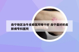 南寧地區(qū)治牛皮癬醫(yī)院哪個好 南寧最好的皮膚病?？漆t(yī)院