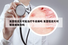 氯雷他定片可能治療牛皮癬嗎 氯雷他定片對銀屑病有效嗎