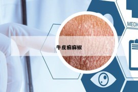 牛皮癬麻椒