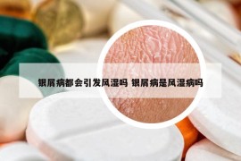 銀屑病都會(huì)引發(fā)風(fēng)濕嗎 銀屑病是風(fēng)濕病嗎