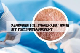 頭部銀屑病用卡泊三醇搽劑多久能好 銀屑病用了卡泊三醇搽劑頭屑反而多了