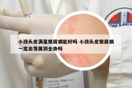 小孩頭皮滿是銀屑病能好嗎 小孩頭皮銀屑病一定會(huì)發(fā)展到全身嗎